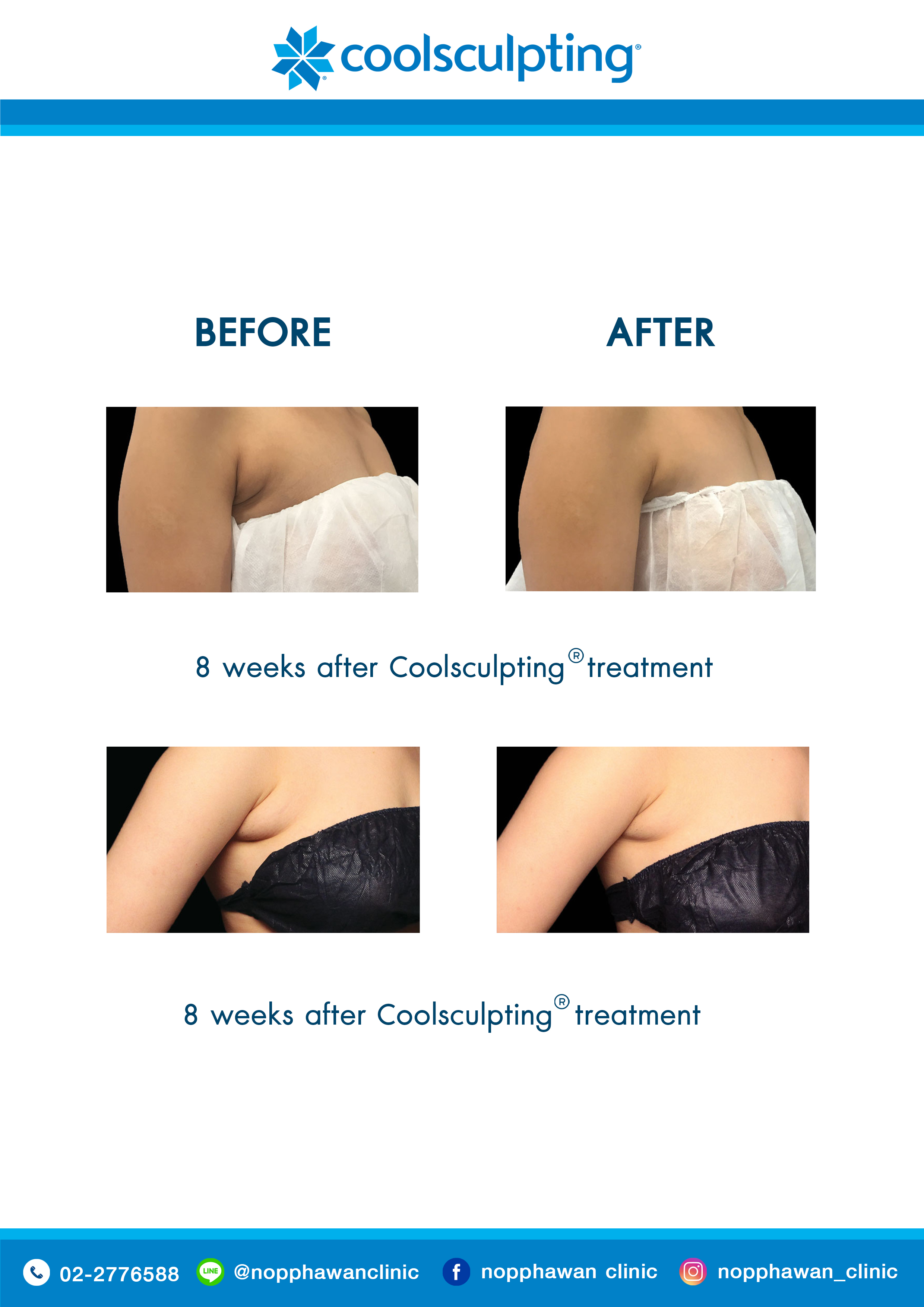 Coolsculpting1