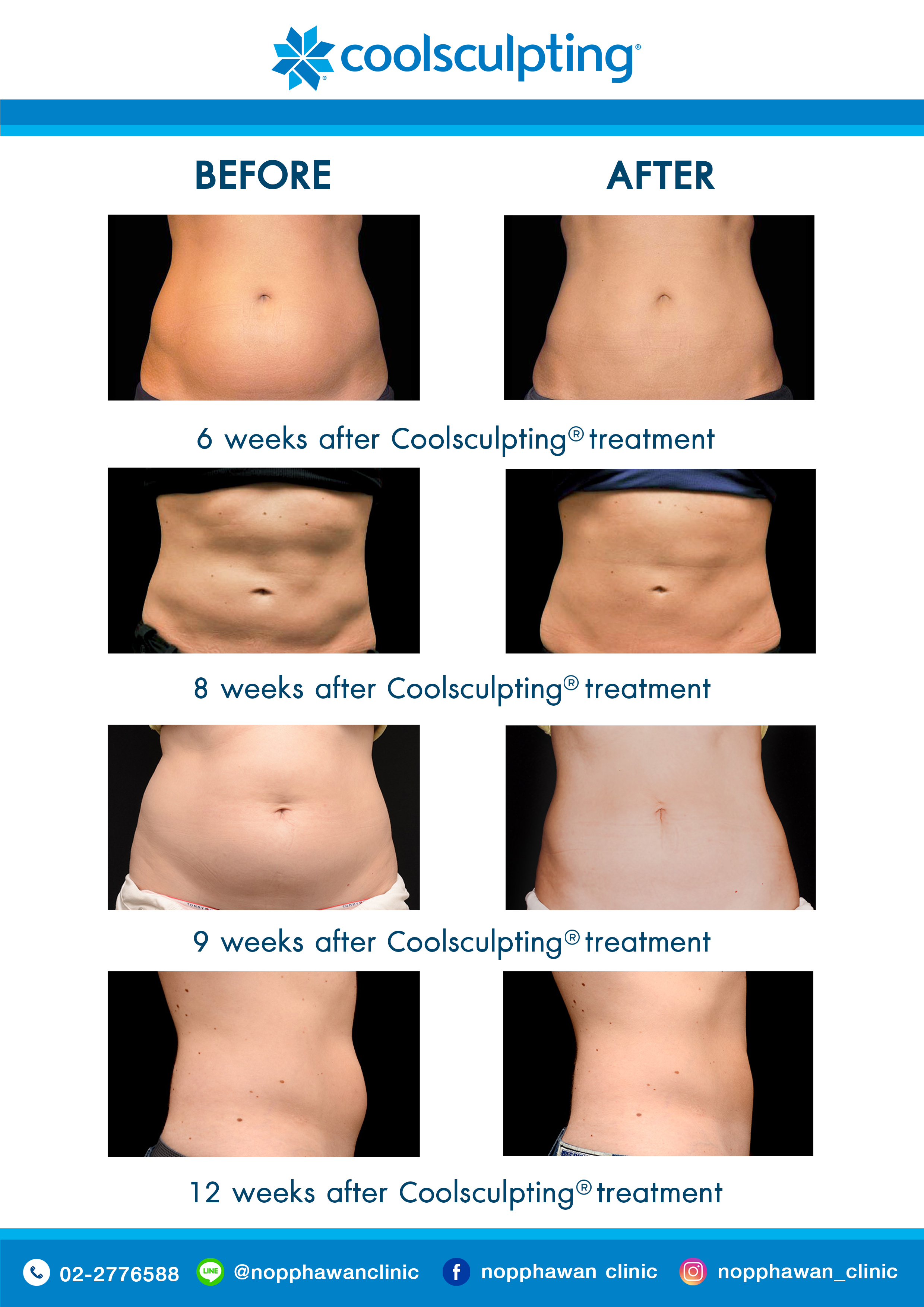 Coolsculpting2