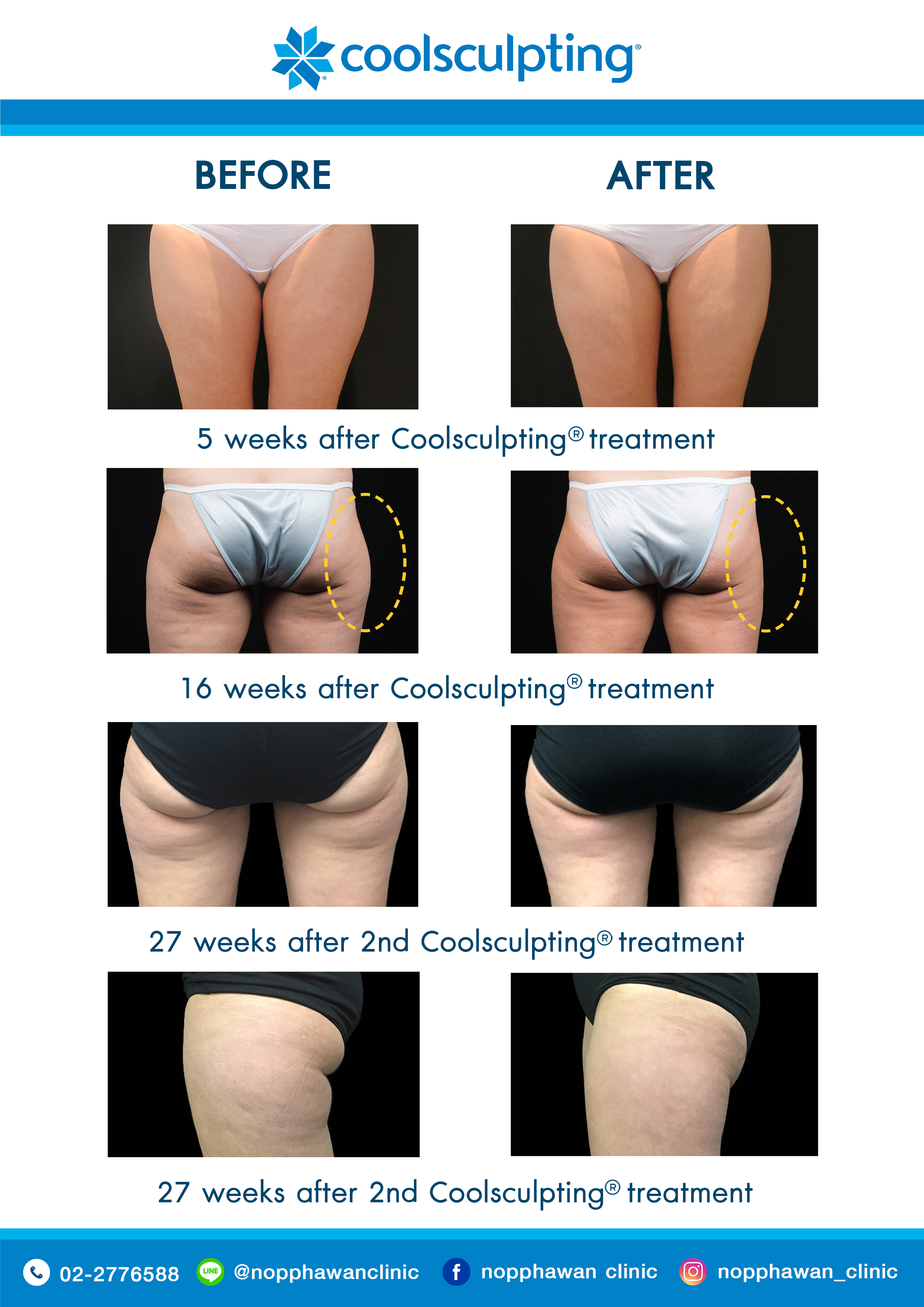 Coolsculpting4
