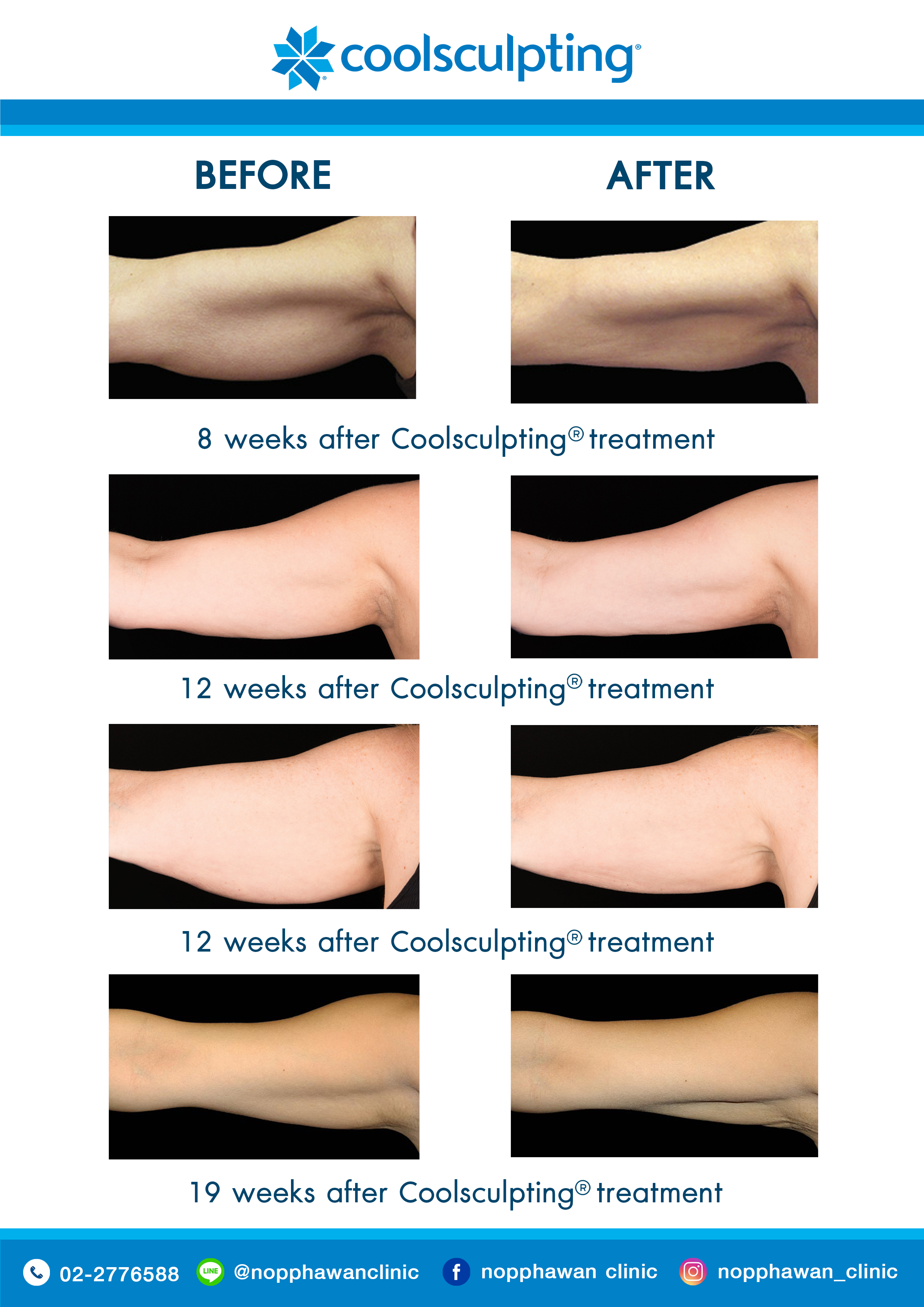 Coolsculpting5