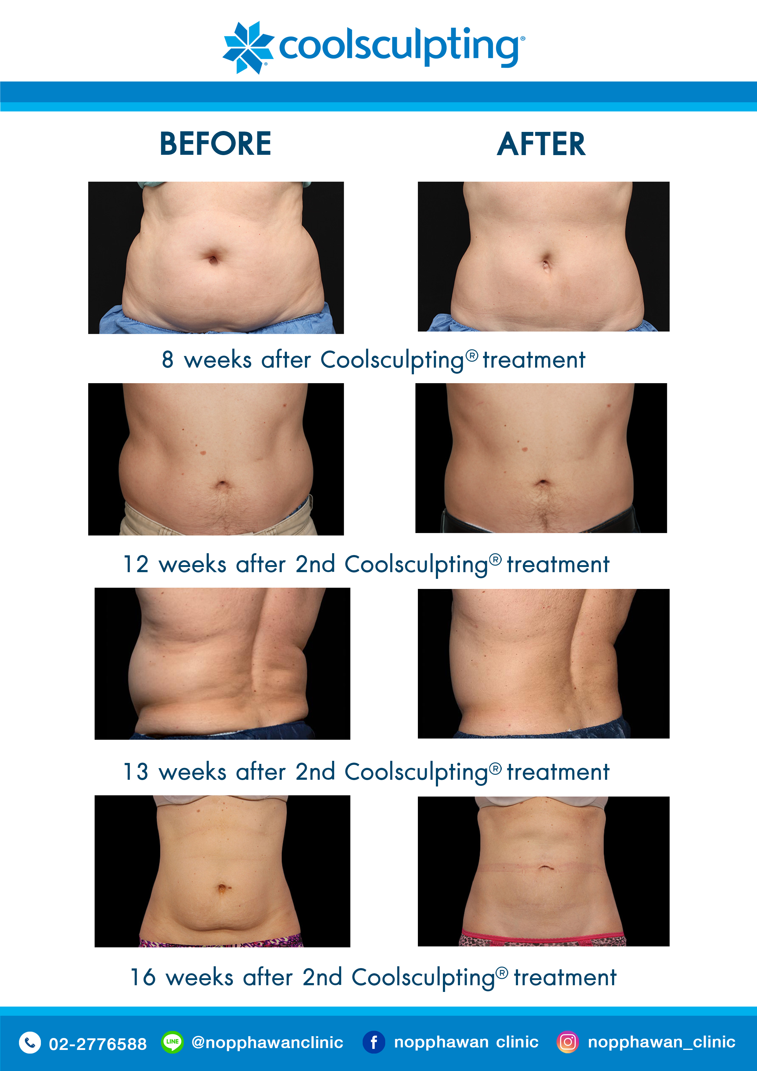 Coolsculpting7