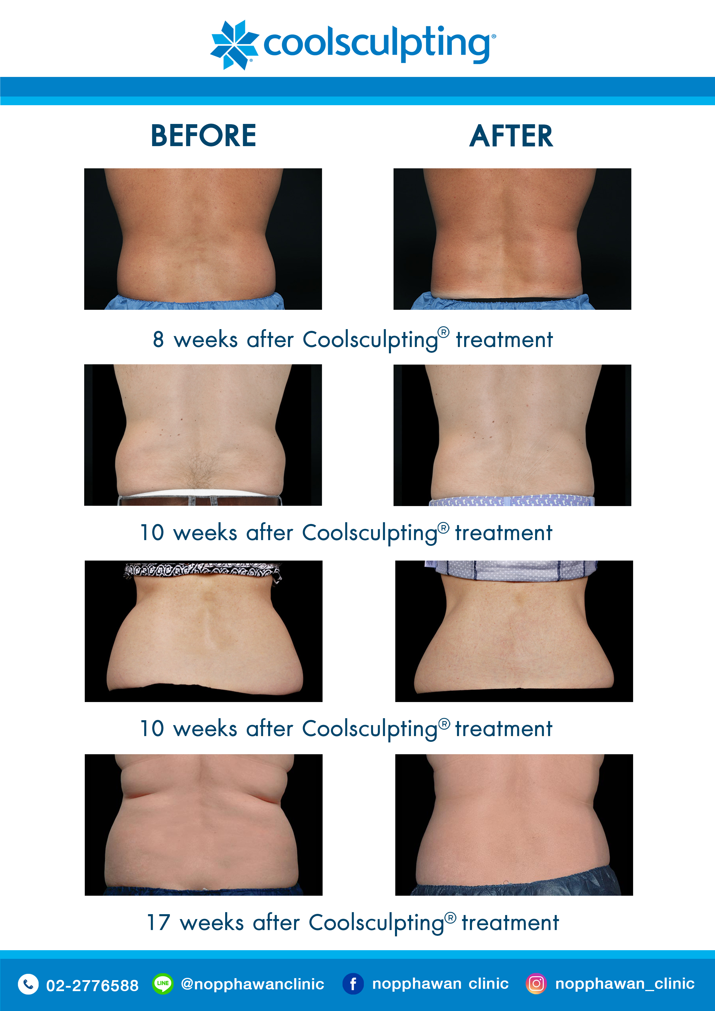 Coolsculpting8