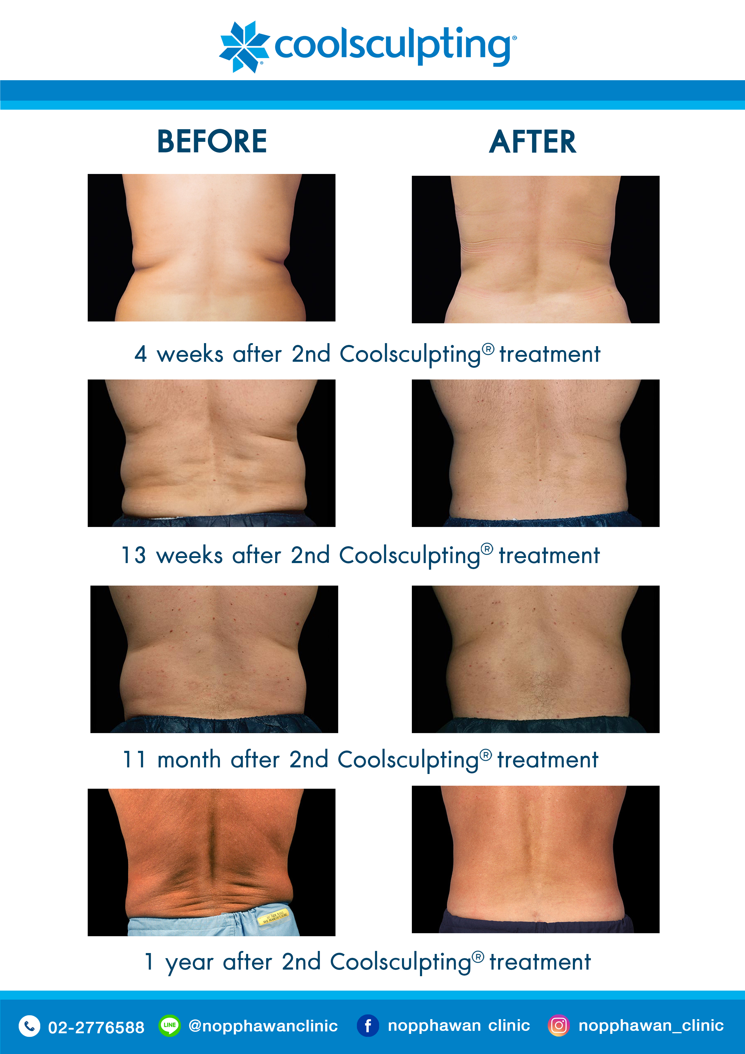 Coolsculpting9